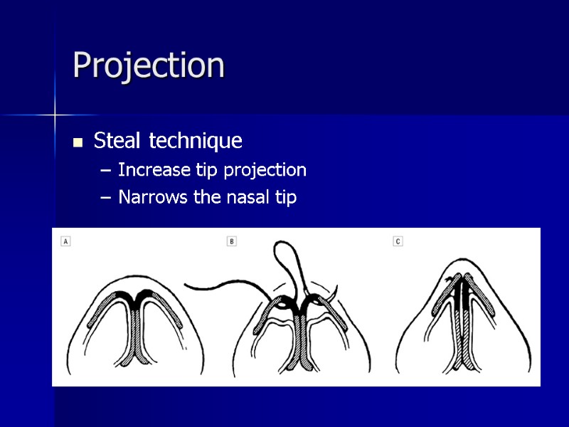 Steal technique Increase tip projection Narrows the nasal tip Projection